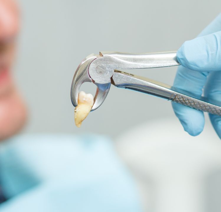 Tooth Extraction in HSR Layout Bangalore
