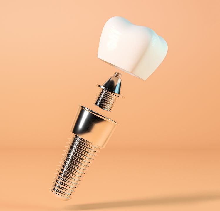 Dental Implants in HSR Layout Bangalore: